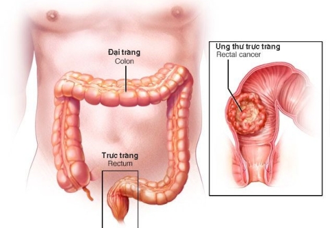 Hướng dẫn bệnh nhân sau mổ cắt trực tràng điều trị ung thư trực tràng